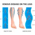 Symptoms Of  Varicose Veins And Their Treatment