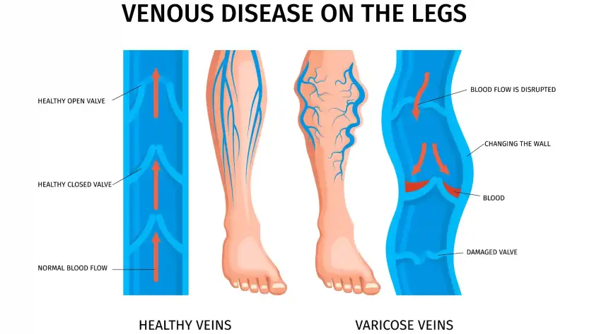 noninvasive varicose veins treatment
